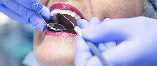 Best Knocked-Out Tooth (Avulsed Tooth) Treatment in Montpelier, IN